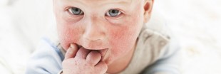 Comprendre l'eczéma des enfants