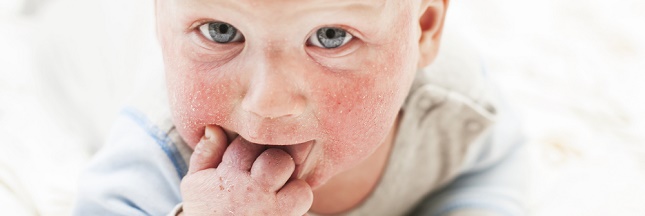 Comprendre l’eczéma des enfants