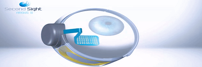Avancée technologique pour les aveugles : le premier oeil bionique !
