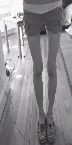 thigh-gap-anorexie