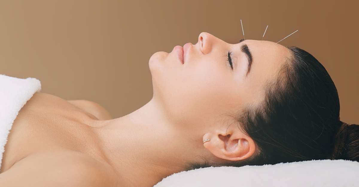L'acupuncture, nouvel allié minceur ?