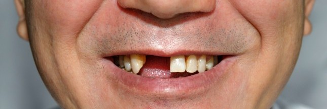 Les dents soignées par un médicament contre Alzheimer