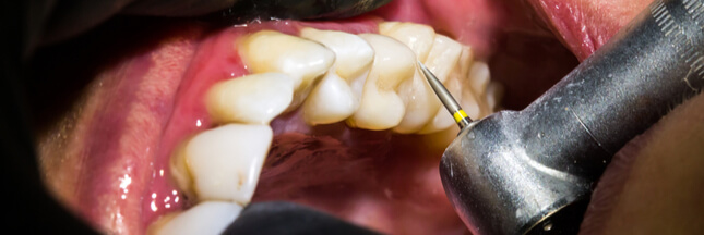 Des chercheurs font repousser l’émail dentaire pour soigner les caries