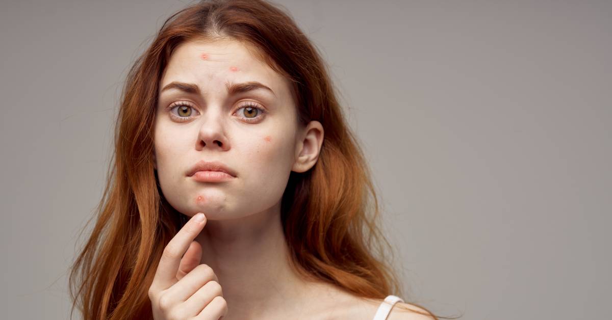 Stop aux boutons en été, toutes les astuces pour lutter contre l'acné estivale Stop aux boutons en été, toutes les astuces pour lutter contre l'acné estivale