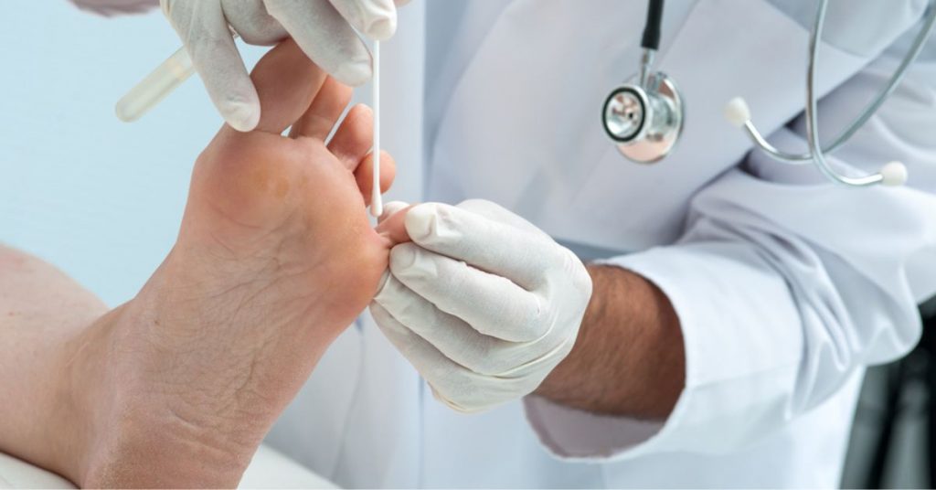 Mycose des pieds : comment soigner naturellement le « pied d’athlète » ?