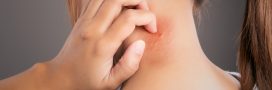 5 astuces naturelles pour soulager les démangeaisons de piqûres de moustiques