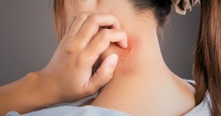 5 astuces naturelles pour soulager les démangeaisons de piqûres de moustiques 5 astuces naturelles pour soulager les démangeaisons de piqûres de moustiques