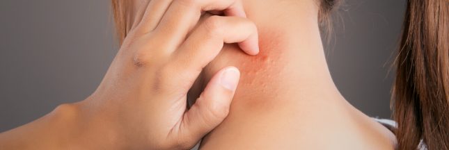 soulager piqure moustique