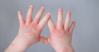 Soigner l'eczema chez les enfants