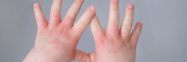 Soigner l'eczema chez les enfants