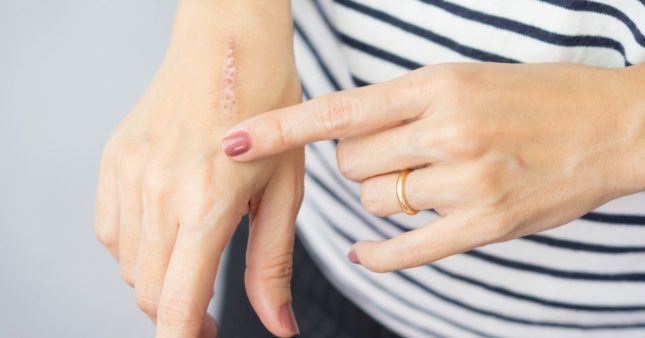 Aromathérapie : les huiles essentielles pour soigner les cicatrices Aromathérapie : les huiles essentielles pour soigner les cicatrices