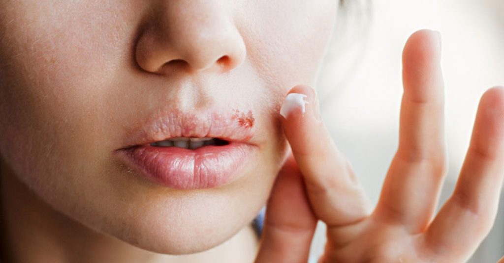 Comment soigner un bouton de fièvre naturellement