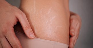 6 recettes naturelles pour prévenir les vergetures 6 recettes naturelles pour prévenir les vergetures