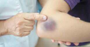 10 remèdes naturels pour faire partir les bleus plus vite 10 remèdes naturels pour faire partir les bleus plus vite