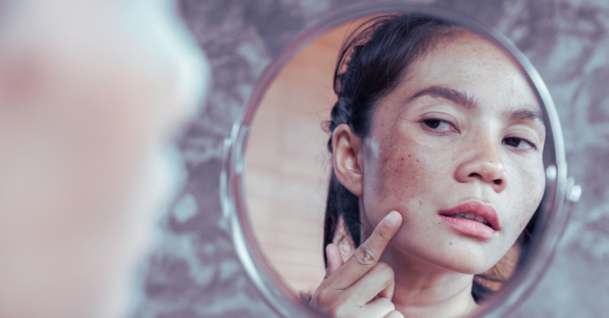 Lentigo : quand le soleil laisse des taches sur la peau