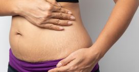 Vergetures : pourquoi elles apparaissent… et ce qui aide vraiment (selon les dermatos)