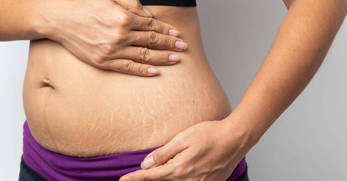 Vergetures : pourquoi elles apparaissent... et ce qui aide vraiment (selon les dermatos) Vergetures : pourquoi elles apparaissent... et ce qui aide vraiment (selon les dermatos)