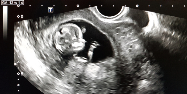 an ultrasound
