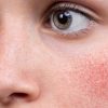Rosacée : routine beauté et traitements naturels