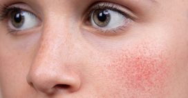 Rosacée : routine beauté et traitements naturels