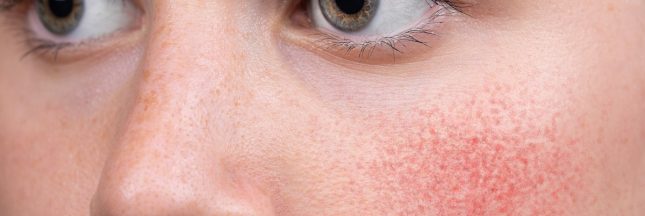 rosacée traitement naturel