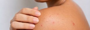 Comment se débarrasser des boutons de chaleur