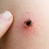 Maladie de Lyme : l'argent colloïdal, un traitement prometteur Maladie de Lyme : l'argent colloïdal, un traitement prometteur