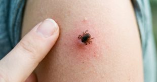 Maladie de Lyme : l'argent colloïdal, un traitement prometteur Maladie de Lyme : l'argent colloïdal, un traitement prometteur