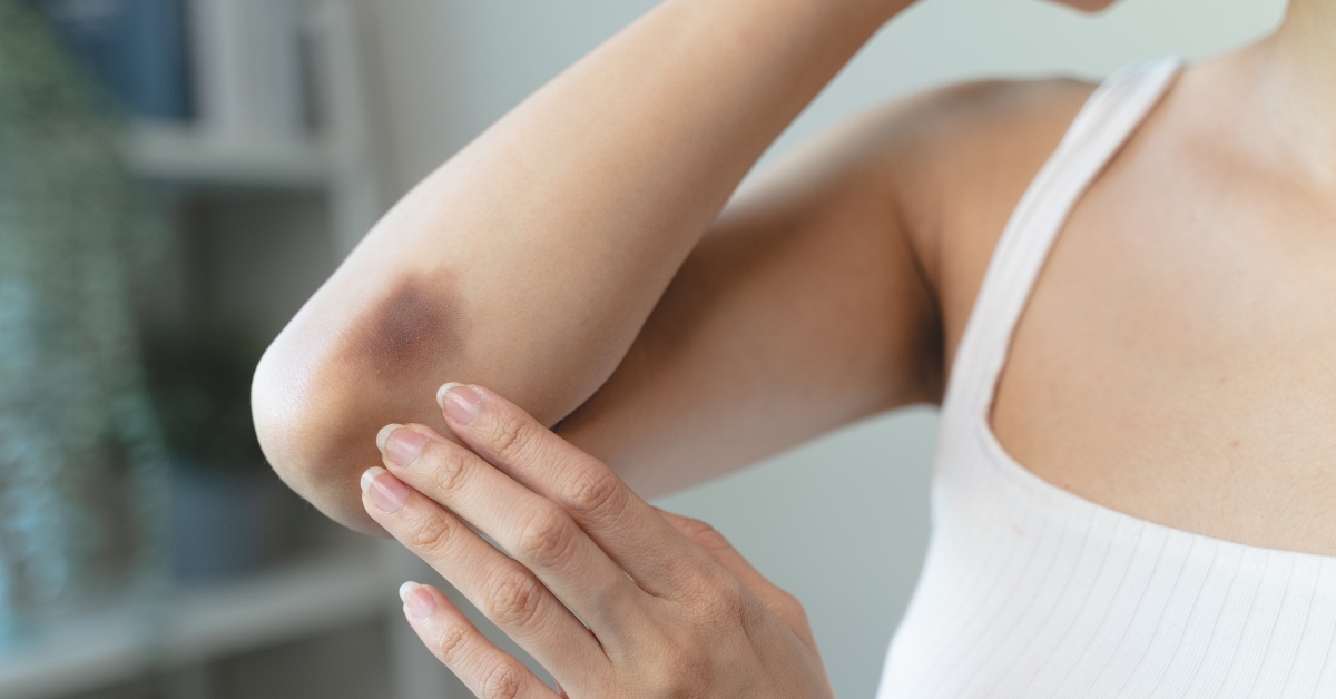 10 remèdes naturels pour faire partir les bleus plus vite