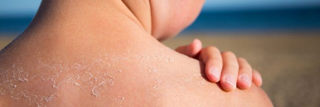 Un coup de soleil chez un enfant