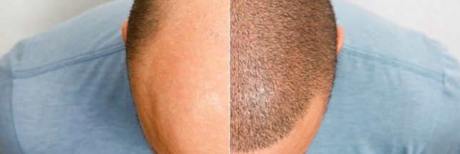 Faire une greffe de cheveux à Istanbul