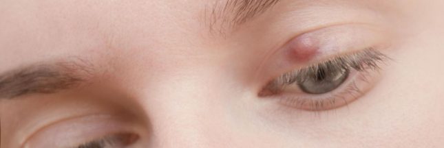 Qu'est-ce qu'un orgelet ?