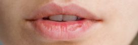 Lèvres gercées : 5 mauvaises habitudes à bannir pour les éviter