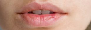 Lèvres gercées : 5 mauvaises habitudes à bannir pour les éviter