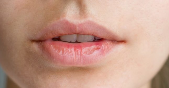 Éviter et réparer les lèvres gercées