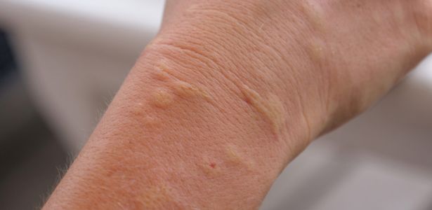 Reconnaître les signes d'une allergie aux piqûres de moustiques