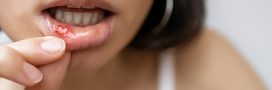 Aphtes : quels aliments éviter ?