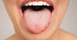 Côtés de la langue ondulés : faut-il s’inquiéter ?