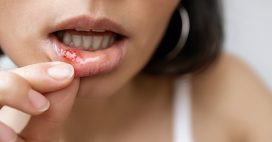 Soigner les aphtes avec des remèdes naturels