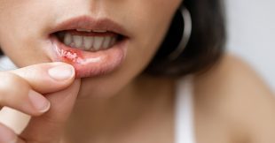 Soigner les aphtes avec des remèdes naturels