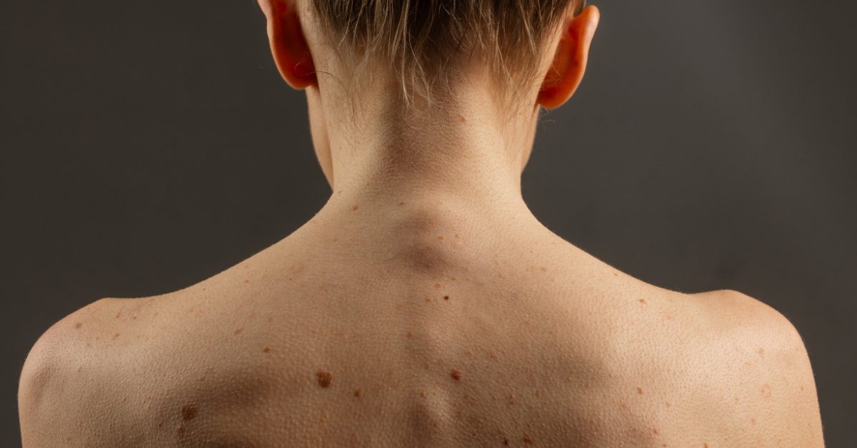 Comment savoir si un grain de beauté est suspect ?