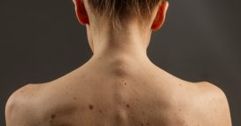 Comment savoir si un grain de beauté est suspect ?