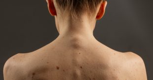 Comment savoir si un grain de beauté est suspect ? Comment savoir si un grain de beauté est suspect ?