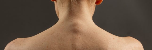 grain de beauté dans le dos