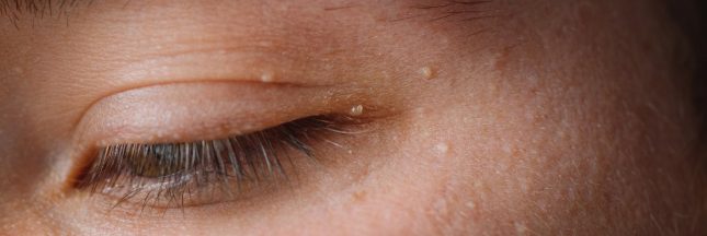 bouton ou grain de milium autour de l'oeil