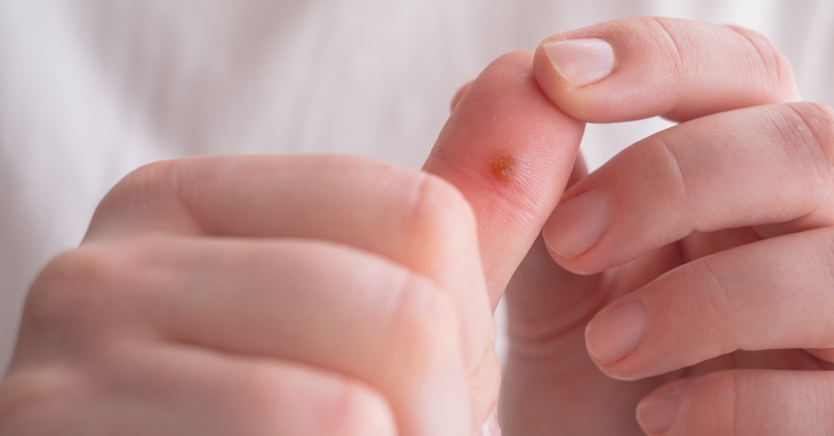 Une verrue ? 5 astuces naturelles pour vous en débarrasser enfin