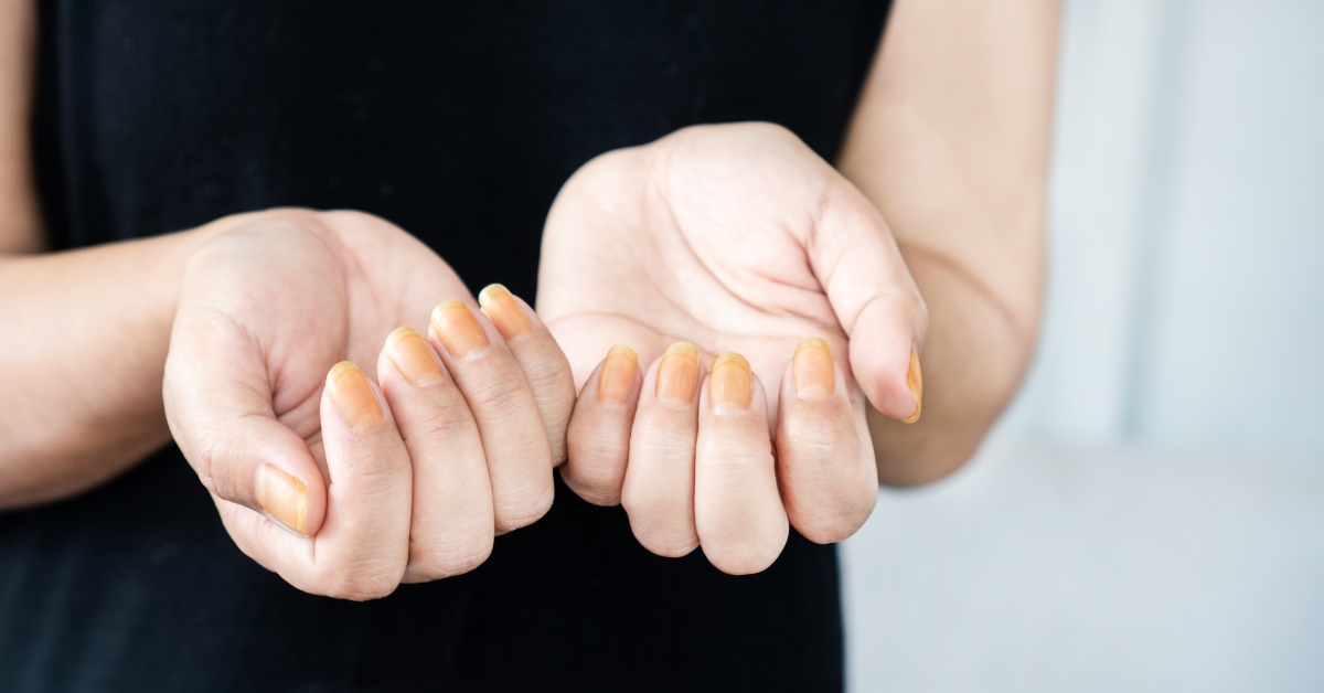 Ongles jaunes : ce qu'ils nous disent et comment s'en débarrasser Ongles jaunes : ce qu'ils nous disent et comment s'en débarrasser