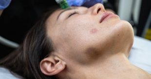 Astuces santé naturelle pour résorber un hématome post-opératoire et un oedème