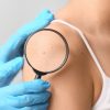 Cancer de la peau : un vaccin personnalisé franchit une étape historique