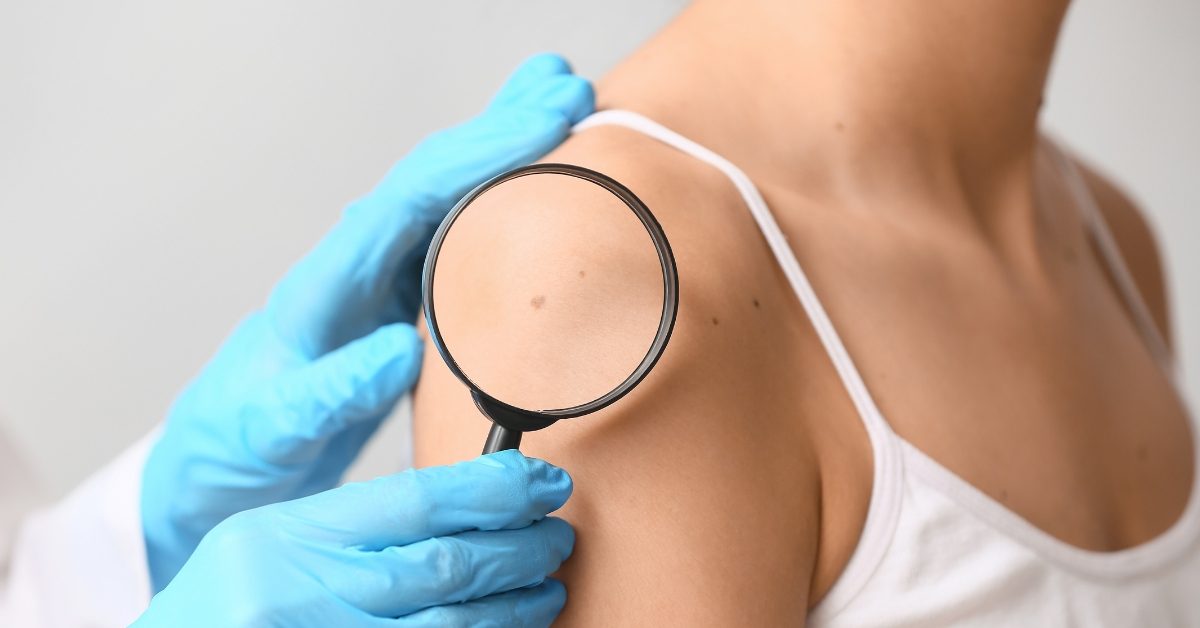 Cancer de la peau : un vaccin personnalisé franchit une étape historique Cancer de la peau : un vaccin personnalisé franchit une étape historique